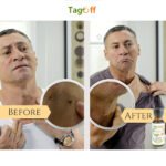 tag off Skin tag remover