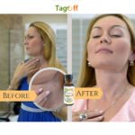 tag off Skin tag remover