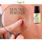 tag off Skin tag remover