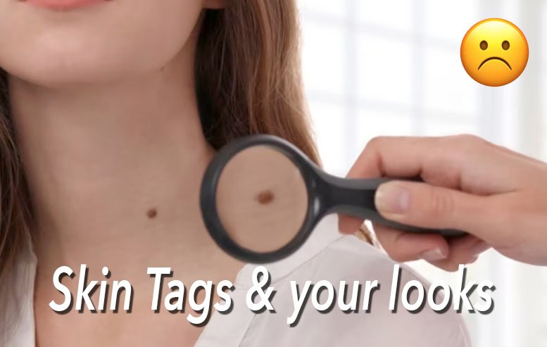 skin tags